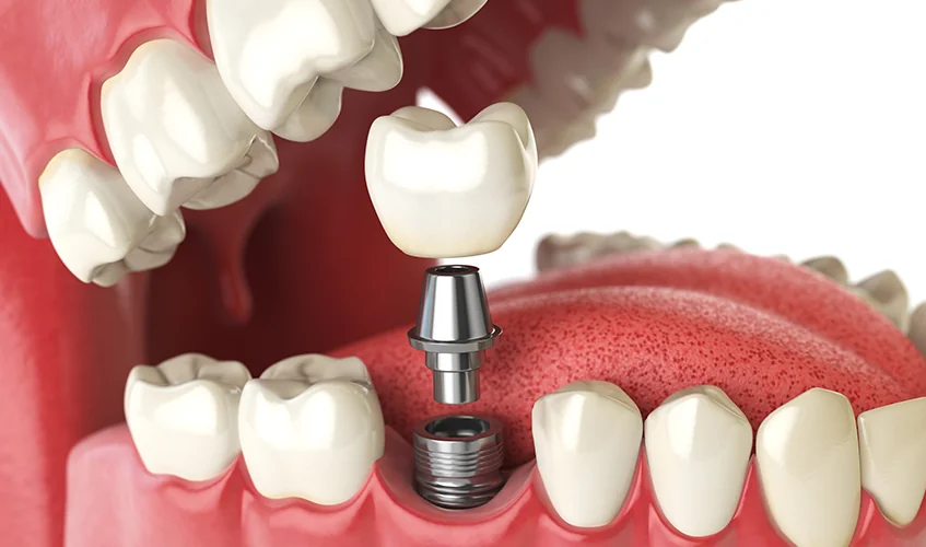 Your Guide to Dental Implant Costs in Massachusetts