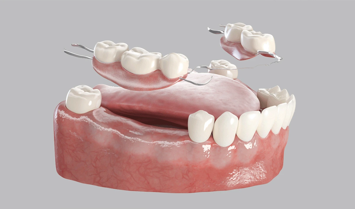 The Stages of Dentures