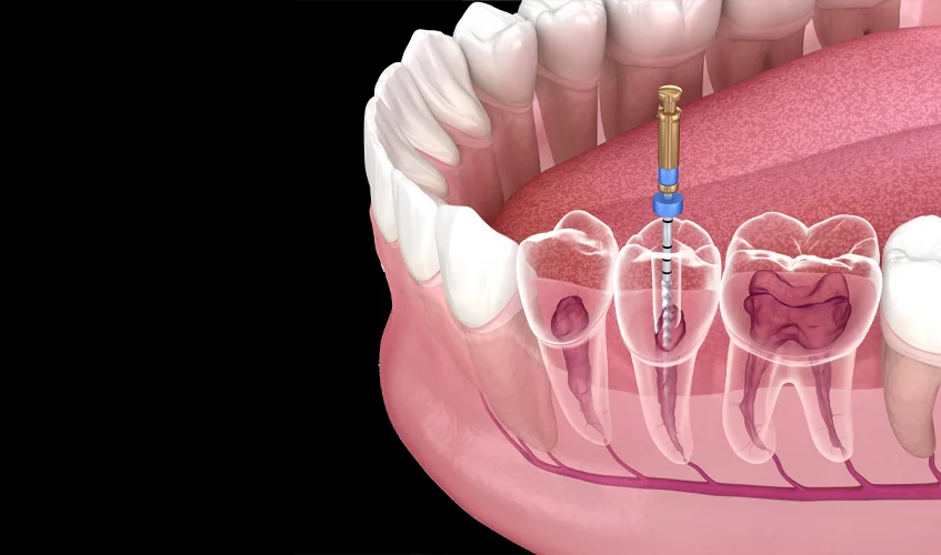 How Much Will My Root Canal in Massachusetts Cost?