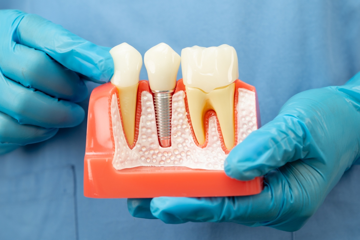 6 Reasons Why Dental Implants Fail And How to Prevent It