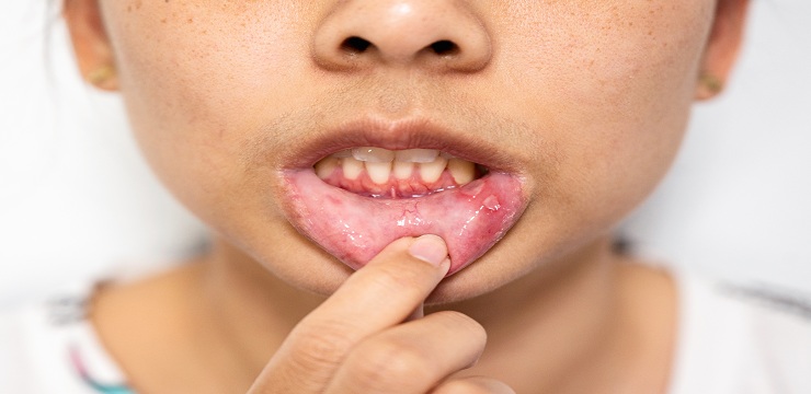 Can Gum Disease Be Reversed With Treatment at Rollstone Family Dental Before It Becomes Severe?