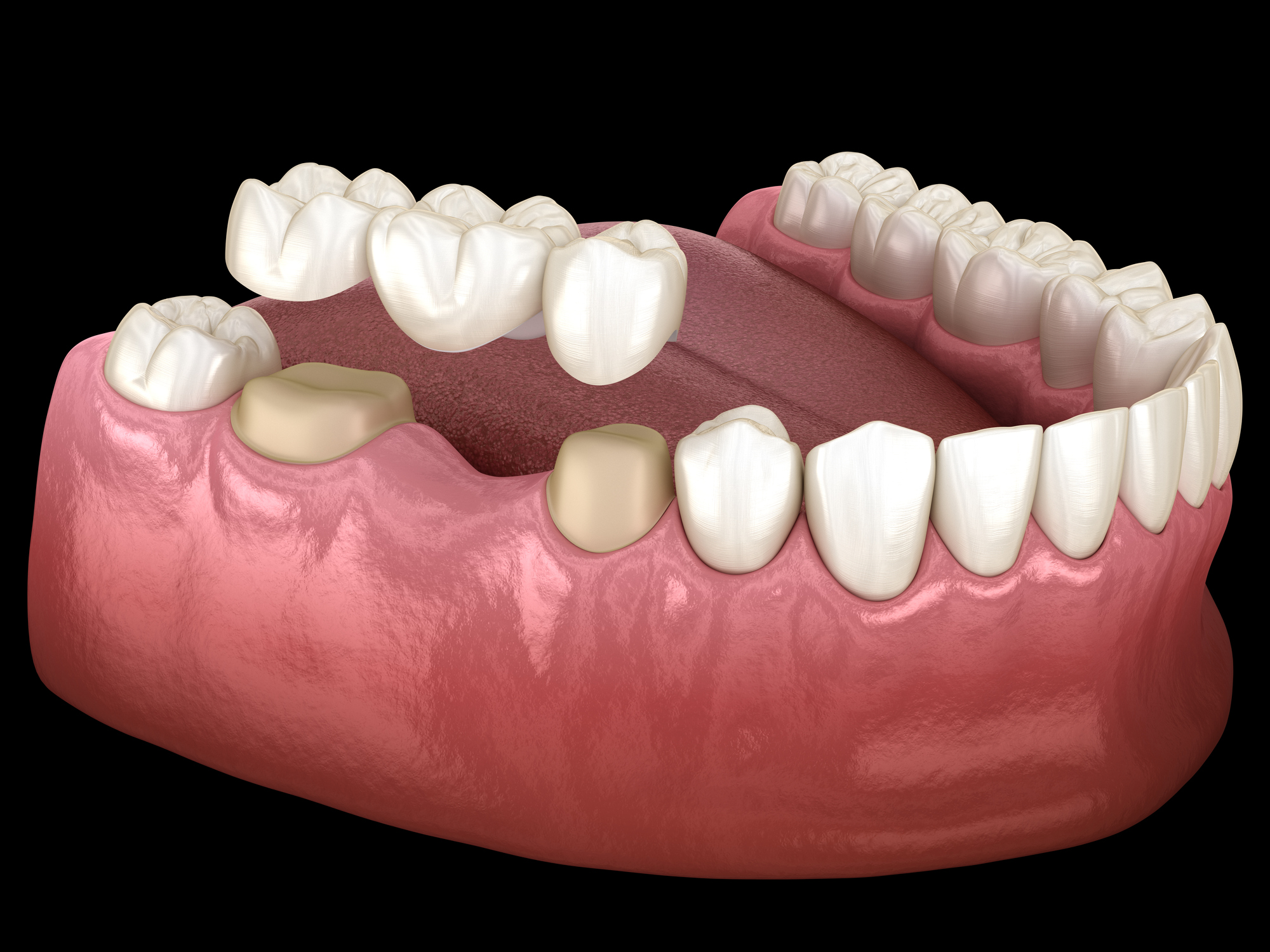When Is a Dental Crown Necessary? A Comprehensive Guide for Fitchburg Patients