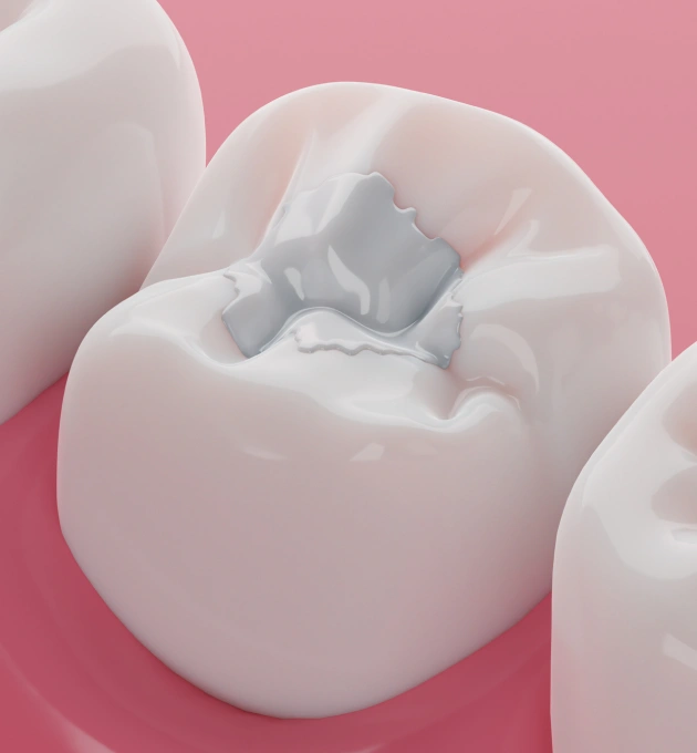 3D illustration of a tooth with composite filling material showing dental restoration technique.