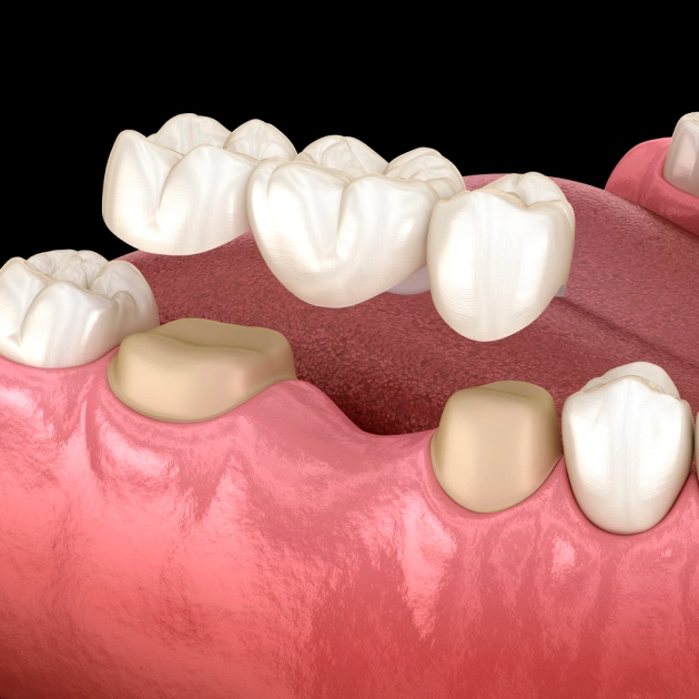 3D illustration of dental bridges replacing missing teeth in the upper and lower jaw.