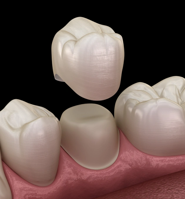 3D illustration of dental crowns on gum model showing tooth restoration placement.