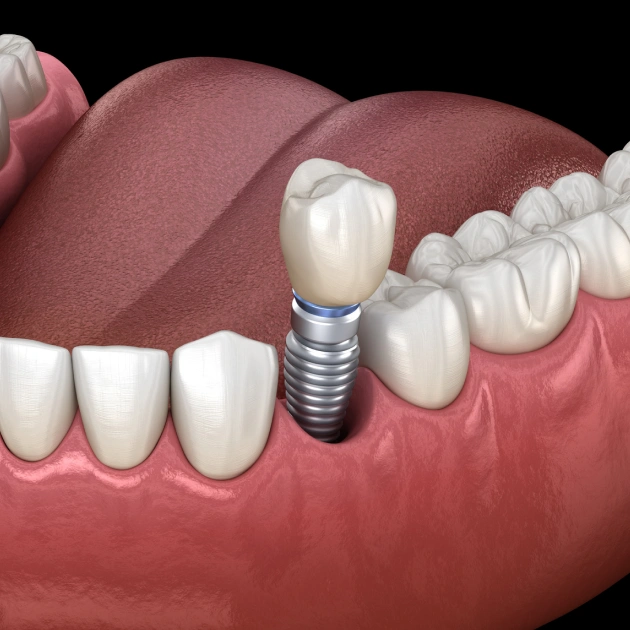 3D dental implant illustration showing a screw-retained crown positioned between natural teeth.
