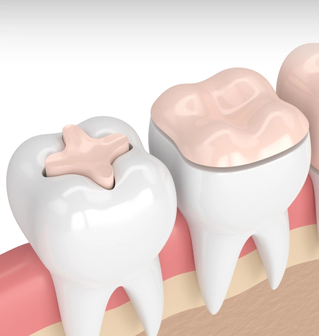 3D illustration of dental inlays and onlays showing tooth restoration options for cavities and damage.