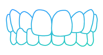 Illustration of a crossbite dental condition showing misaligned upper and lower teeth.