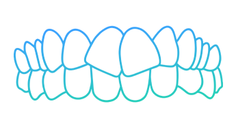 Crowded upper and lower teeth illustration showing misaligned dental condition.