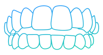Illustration of an open bite malocclusion showing upper and lower teeth misalignment.