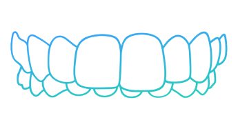 Invisalign clear aligner tray showing correction of overbite misalignment.