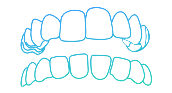Before and after illustration showing teeth gaps closed with Invisalign treatment in Fitchburg, MA.