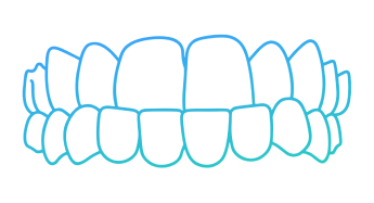 Illustration of corrected teeth alignment showing an underbite treatment result.